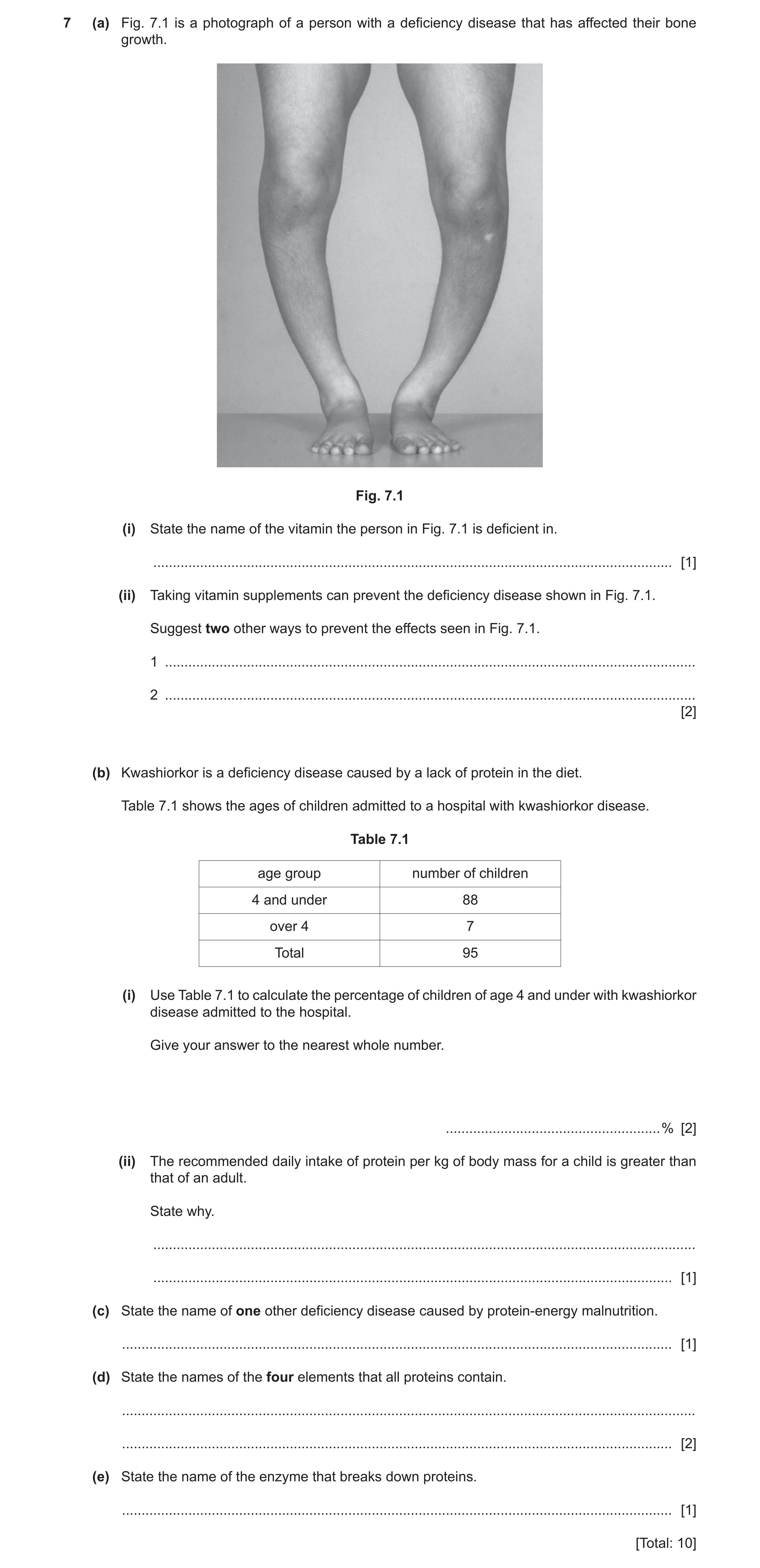 Question 8: (a) Fig. 7.1 is a photograph of a person with a deficiency disease that has affected their bone growth. Fig. 7.1 (i) State the name of the …