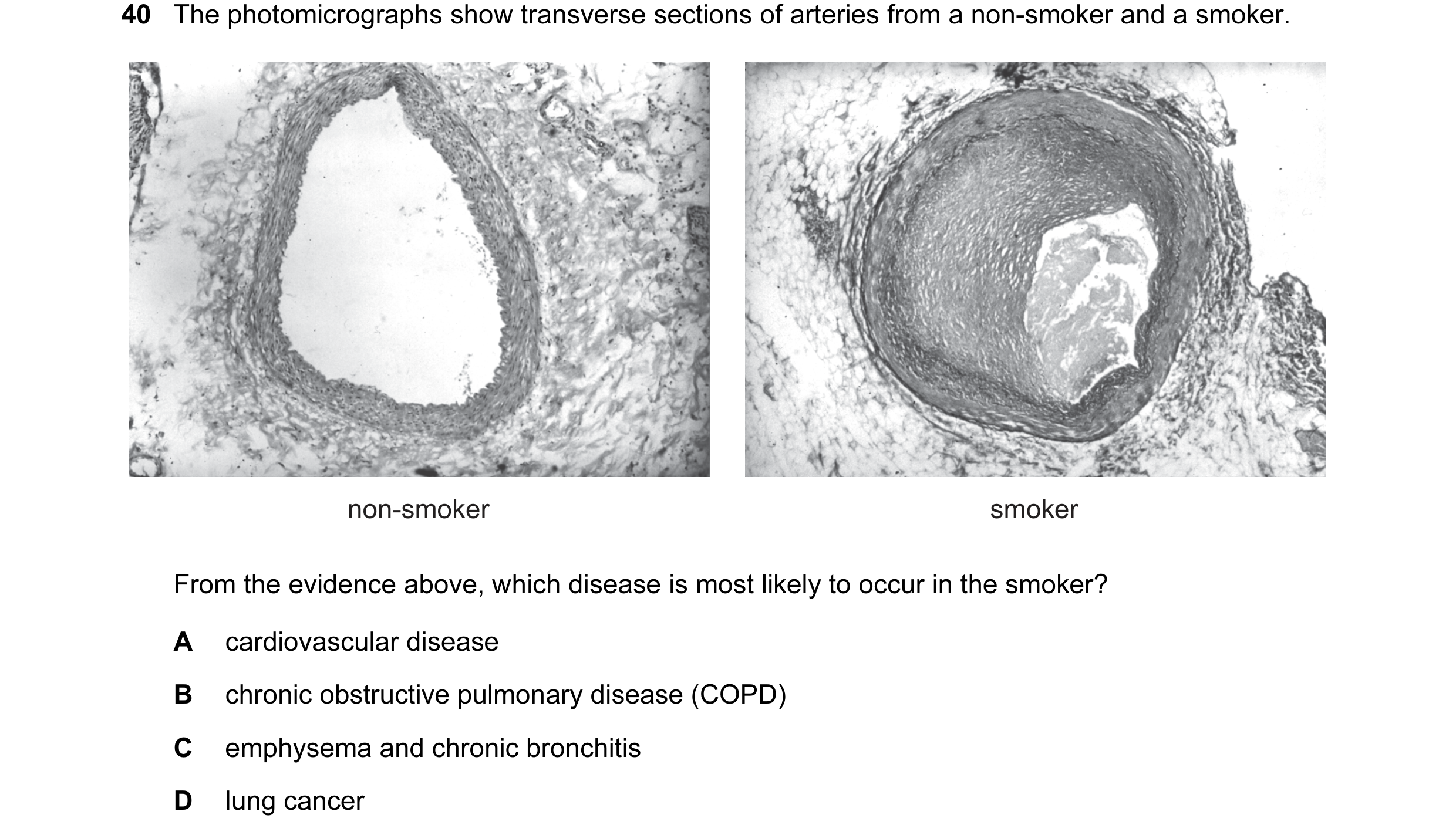 Question 31: The photomicrographs show transverse sections of arteries from a non-smoker and a smoker. non-smoker smoker From the evidence above, which …