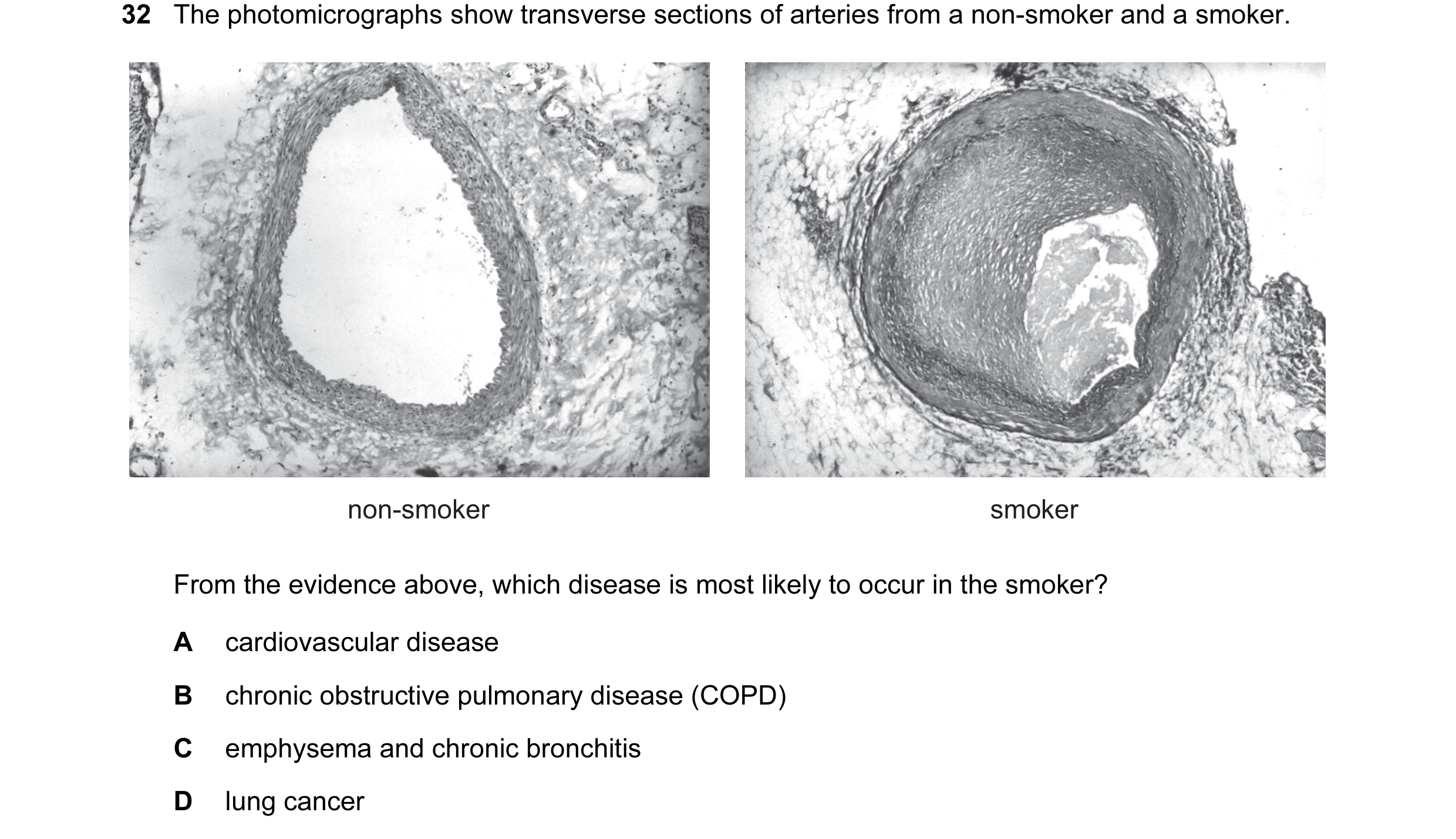 Question 26: The photomicrographs show transverse sections of arteries from a non-smoker and a smoker. non-smoker smoker From the evidence above, which …