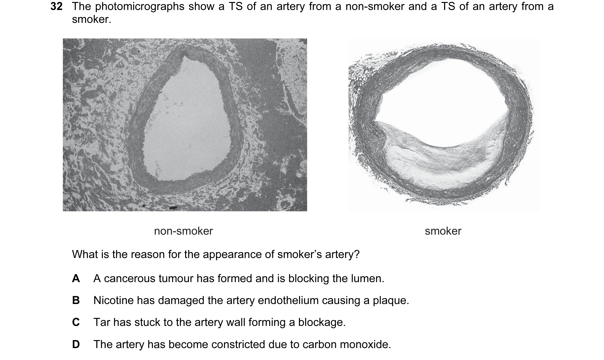 Question 44: The photomicrographs show a TS of an artery from a non-smoker and a TS of an artery from a smoker. non-smoker smoker What is the reason for…