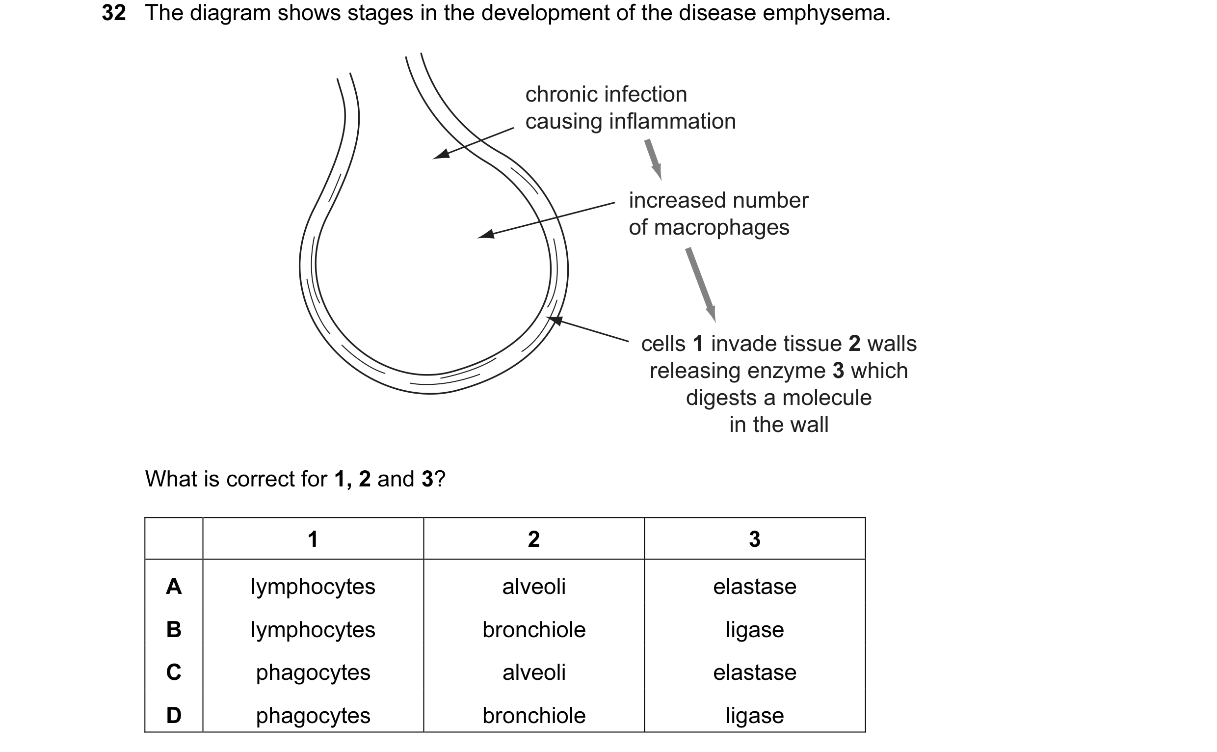 Question 5: The diagram shows stages in the development of the disease emphysema. chronic infection causing inflammation increased number of macrophage…