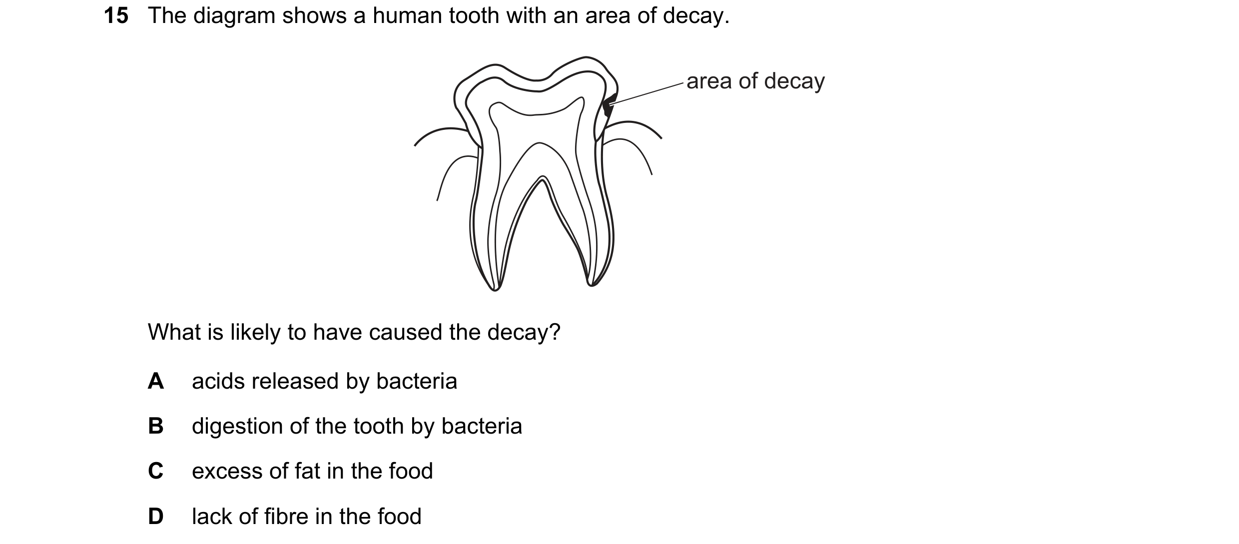 Question 1: The diagram shows a human tooth with an area of decay. area of decay What is likely to have caused the decay? A acids released by bacteria …