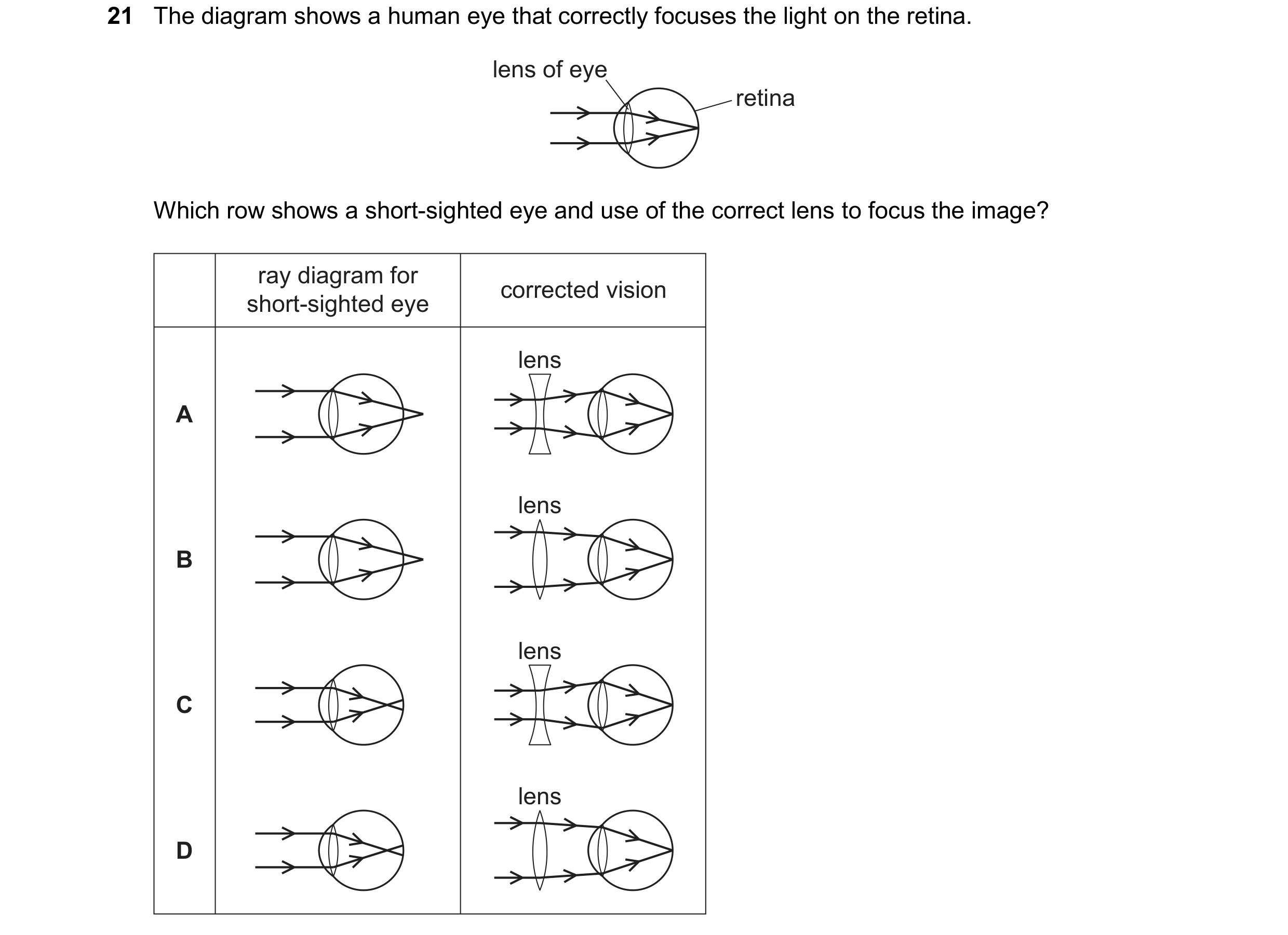 Question 197: The diagram shows a human eye that correctly focuses the light on the retina. lens of eye retina Which row shows a short-sighted eye and us…